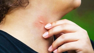 Batı Nil Virüsü, Hollanda'nın başına bela olacak