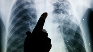 Avrupa'da çocuklarda verem vakaları yüzde10 arttı! 