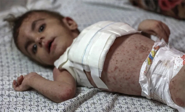 Gazze'den İki Ağır Hasta Çocuk Tedavi İçin Hollanda'ya Getiriliyor