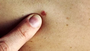 Uzmanlardan Uyarı: Bu On Belirti Kanserin Habercisi Olabilir