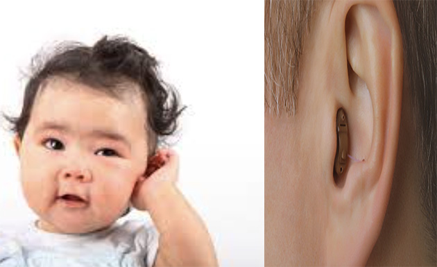 Hollanda’da Bir İlk: Yeni Nesil İşitme İmplantı UMCG’de İki Çocuğa Takıldı