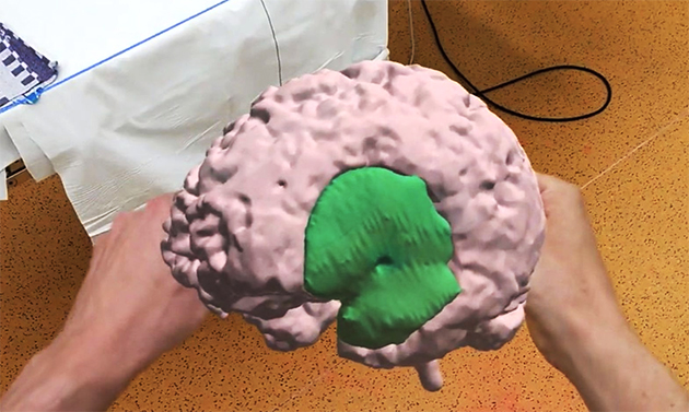 Amsterdam UMC’de İlk Kez Hologram Destekli Beyin Ameliyatı Gerçekleştirildi