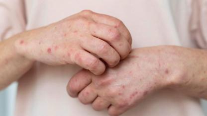 Hollanda'da Bir Hastada Yüksek Bulaşıcı Uyuz Vakası Görüldü