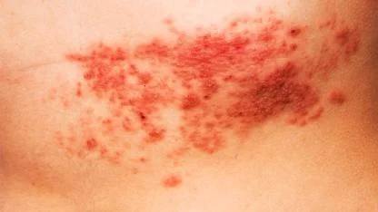 Hollanda’da Milyonlarca 60 Yaş Üstü Kişi Ücretsiz Zona Aşısı Kapsamı Dışında Bırakıldı